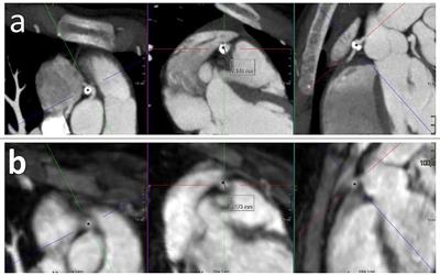 CT Angiography or Cardiac MRI for Detection of Coronary Artery Aneurysms in Kawasaki Disease